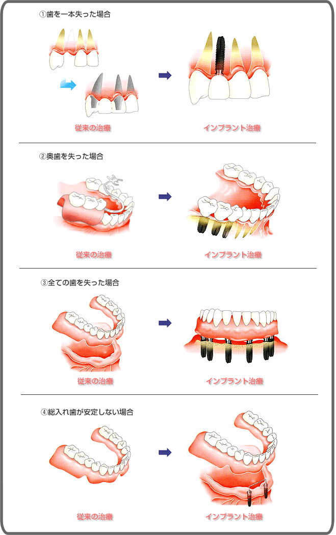 従来の治療法とインプラント治療の違い：大阪市中央区玉造のカガミ歯科医院