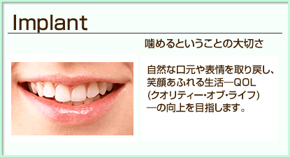 大阪市中央区玉造のカガミ歯科医院のインプラント治療