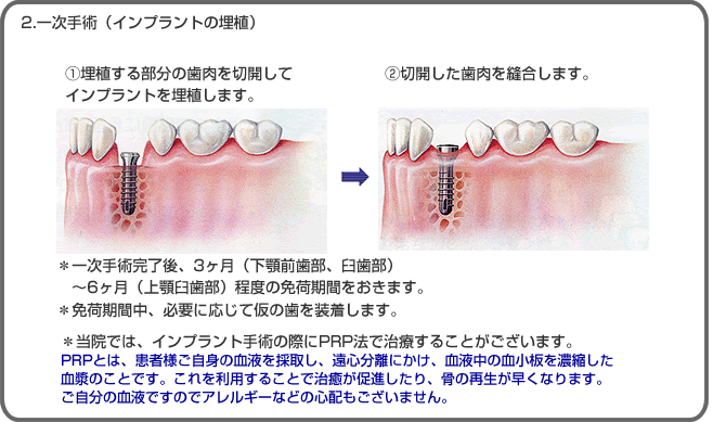 インプラント治療の流れ：大阪市中央区玉造のカガミ歯科医院