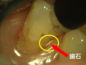 歯科衛生士使用のマイクロスコープ（顕微鏡）治療：大阪市中央区玉造の