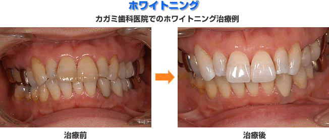 カガミ歯科医院でのホワイトニング治療例